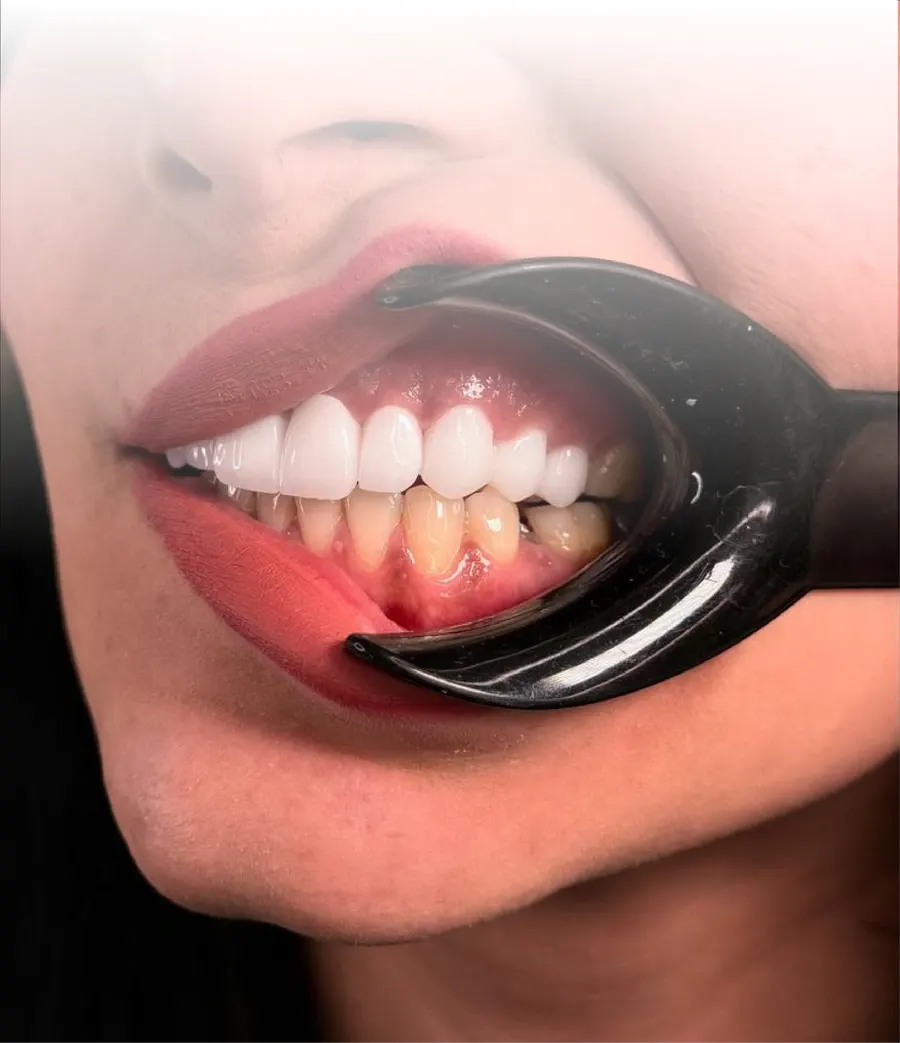 Bielenie zubov Pure Whitening